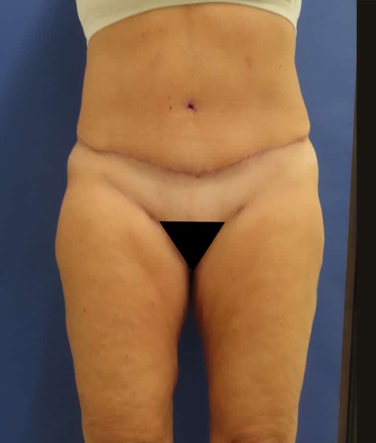 After Image: Patient # 4672 - front