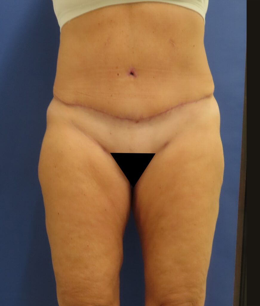 After Image: Patient # 4672 - front