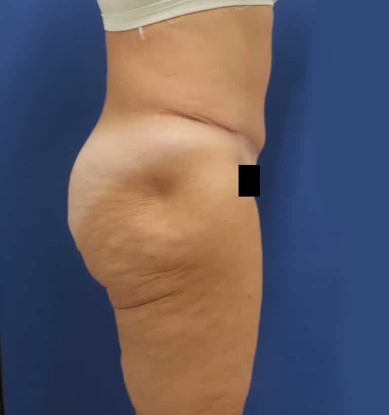 After Image: Patient # 4672 - right-side
