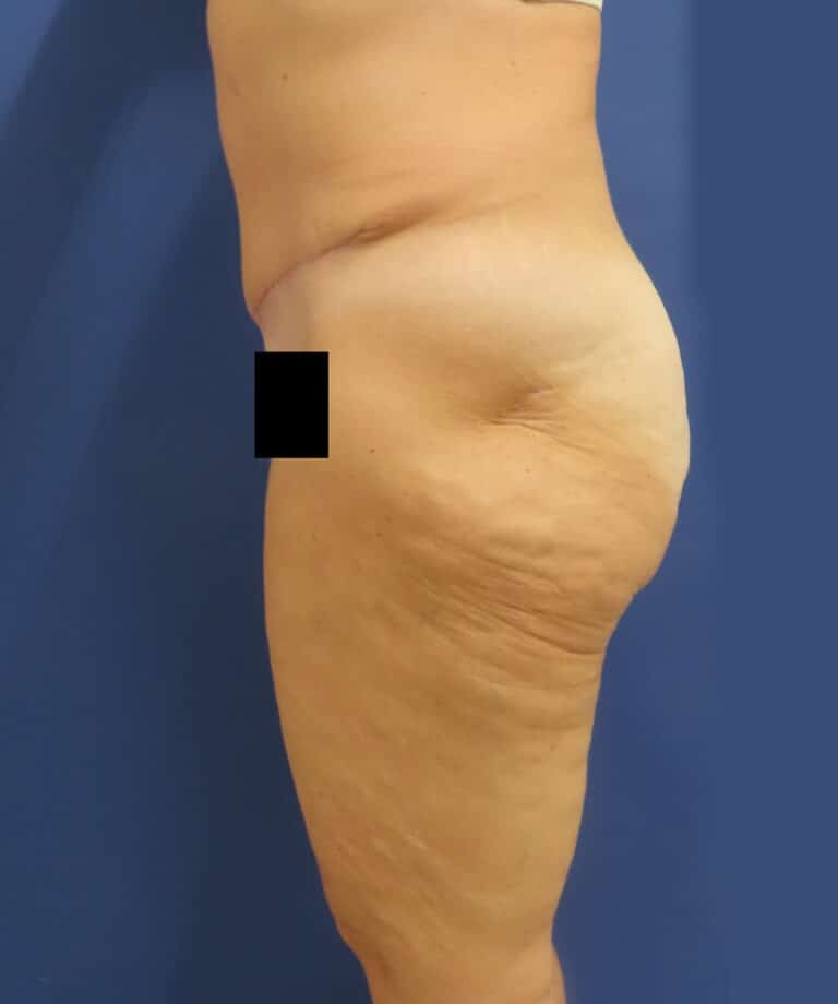 After Image: Patient # 4672 - left-side