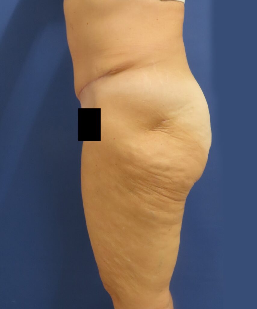 After Image: Patient # 4672 - left-side