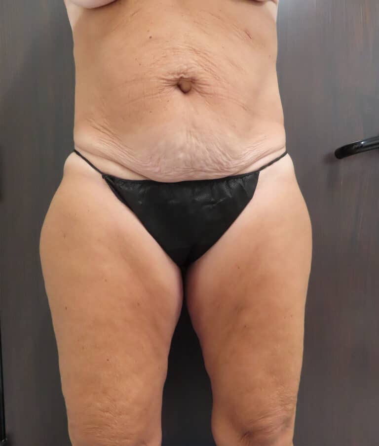 Before Image: Patient # 4672 - front