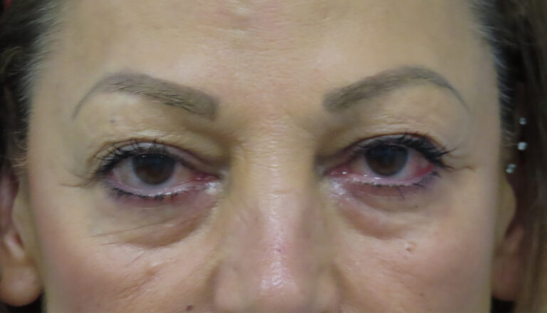 Before Image: Patient # 4716 - front