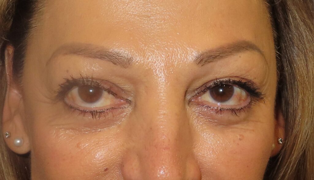 After Image: Patient # 4716 - front