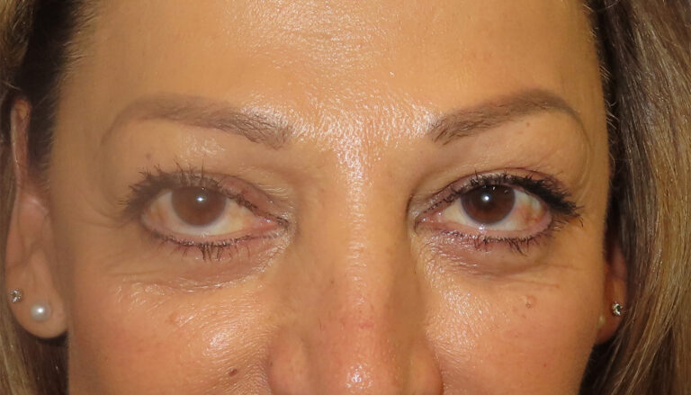 After Image: Patient # 4716 - front