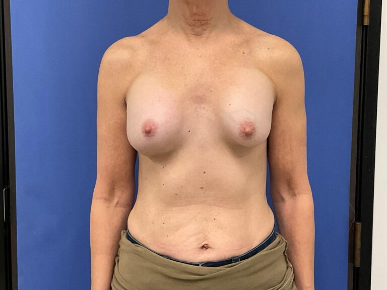 Before Image: Patient # 4892 - front