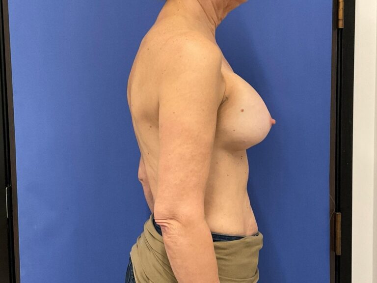 Before Image: Patient # 4892 - right-side