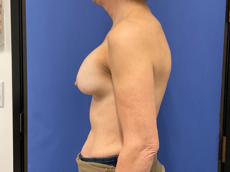 Before Image: Patient # 4892 - left-side