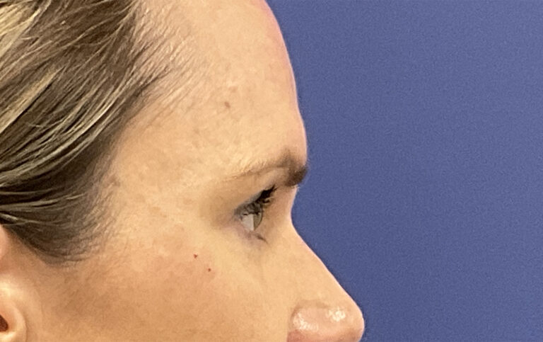 After Image: Patient # 4916 - right-side