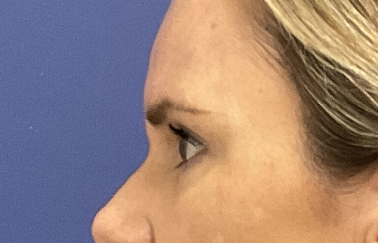 After Image: Patient # 4916 - left-side
