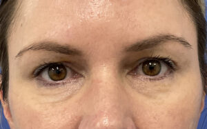 Before Image: Patient # 4916