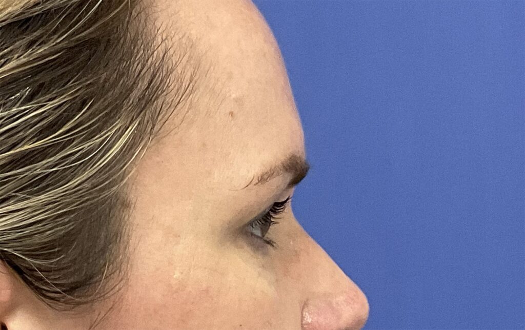 Before Image: Patient # 4916 - right-side