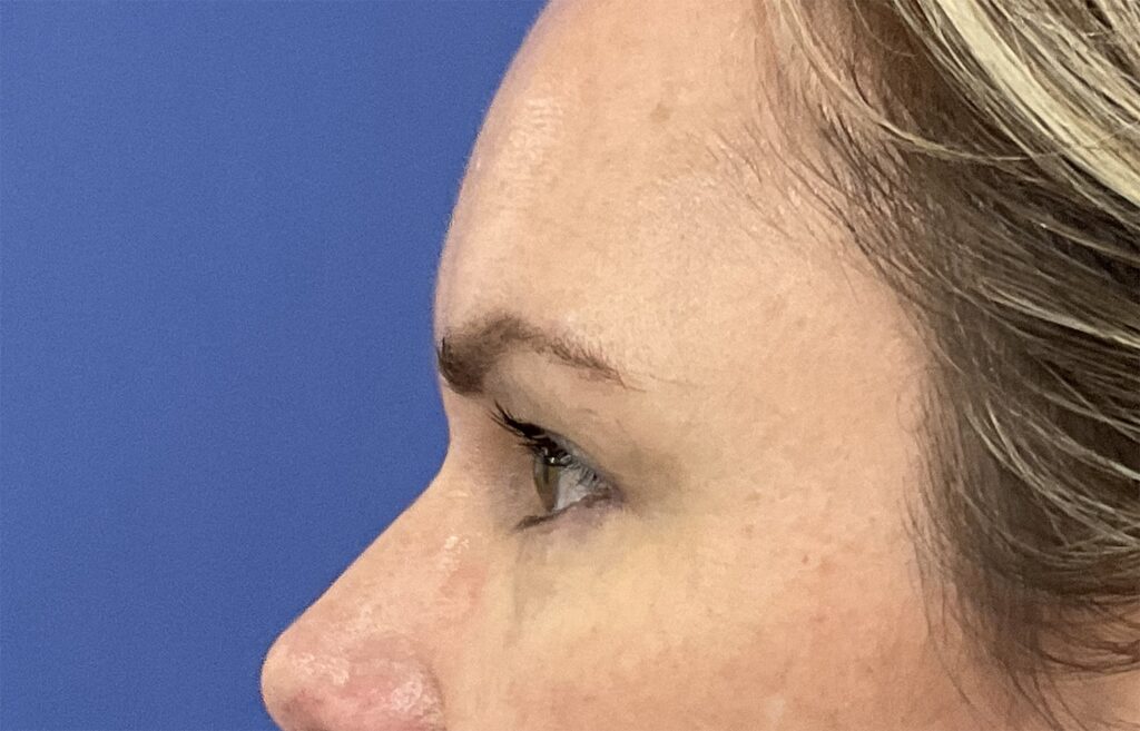 Before Image: Patient # 4916 - left-side