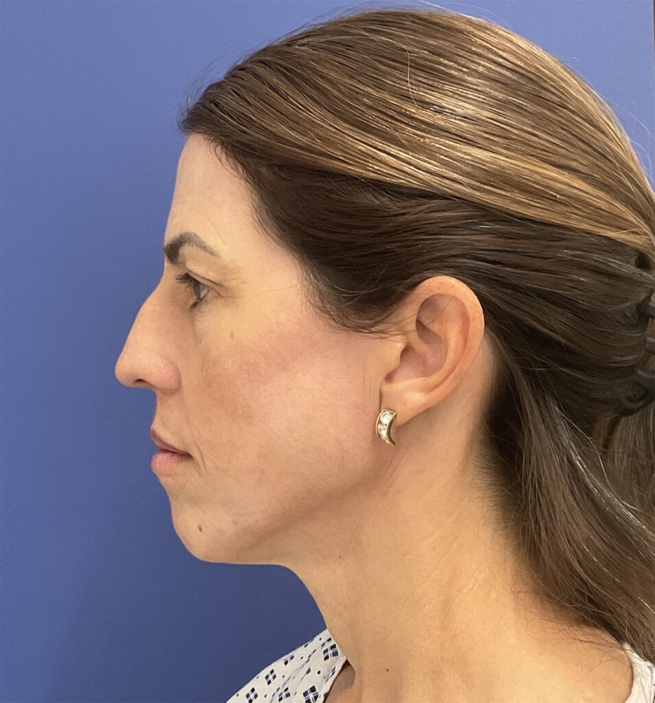 After Image: Croton Oil Peel and Blepharoplasty - 