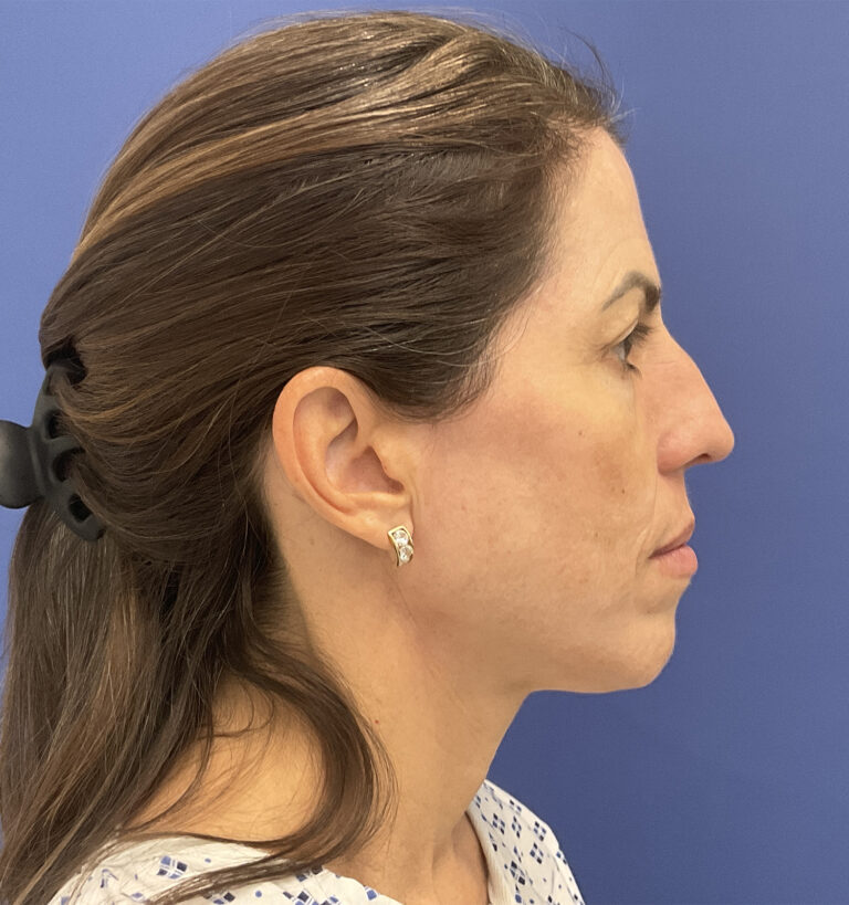 After Image: Croton Oil Peel and Blepharoplasty - right-side