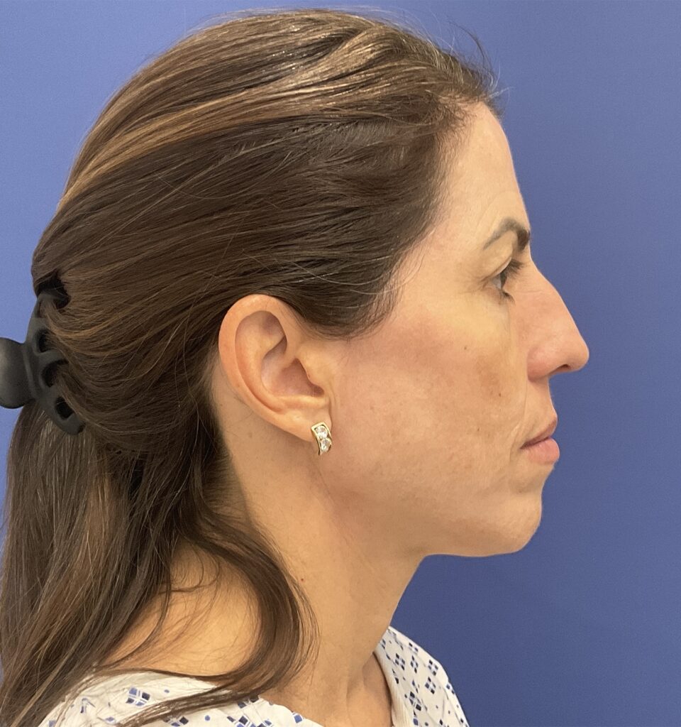 After Image: Croton Oil Peel and Blepharoplasty - right-side