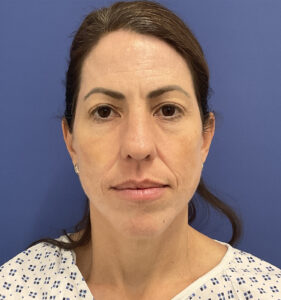 Croton Oil Peel and Blepharoplasty