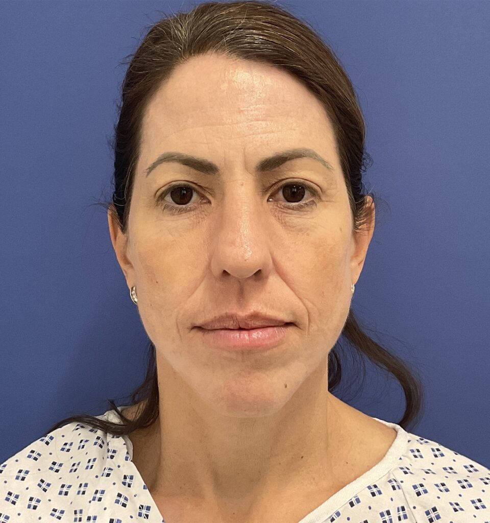 After Image: Croton Oil Peel and Blepharoplasty - front