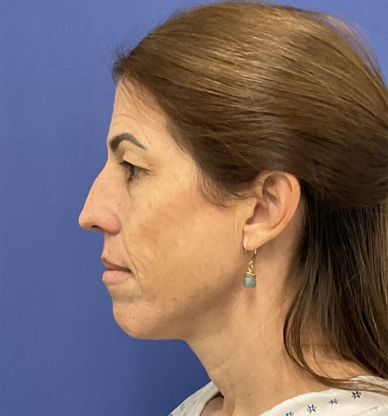 Before Image: Croton Oil Peel and Blepharoplasty -