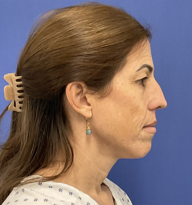 Before Image: Croton Oil Peel and Blepharoplasty - right-side