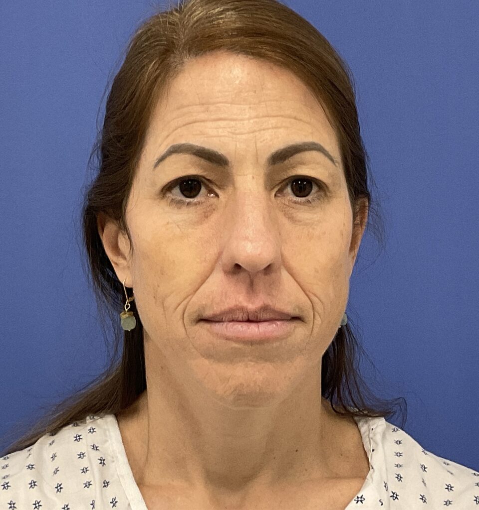 Before Image: Croton Oil Peel and Blepharoplasty - front