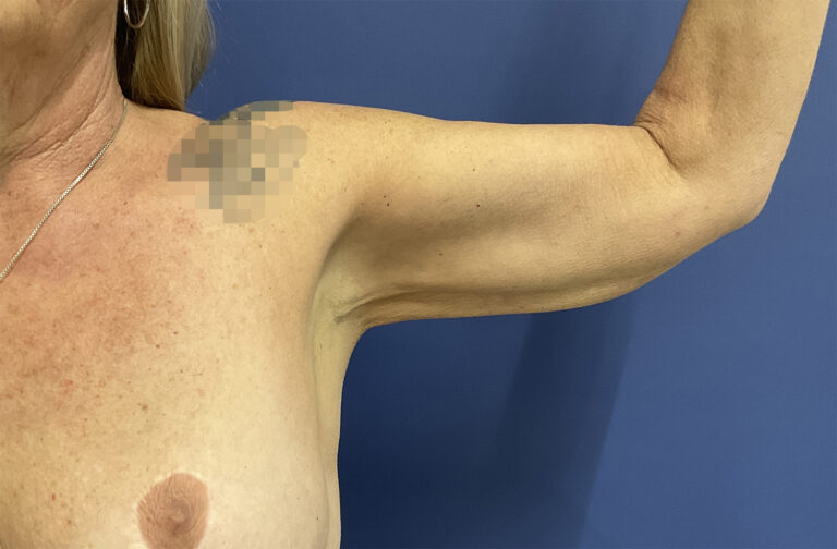 After Image: Patient # 82254 - front