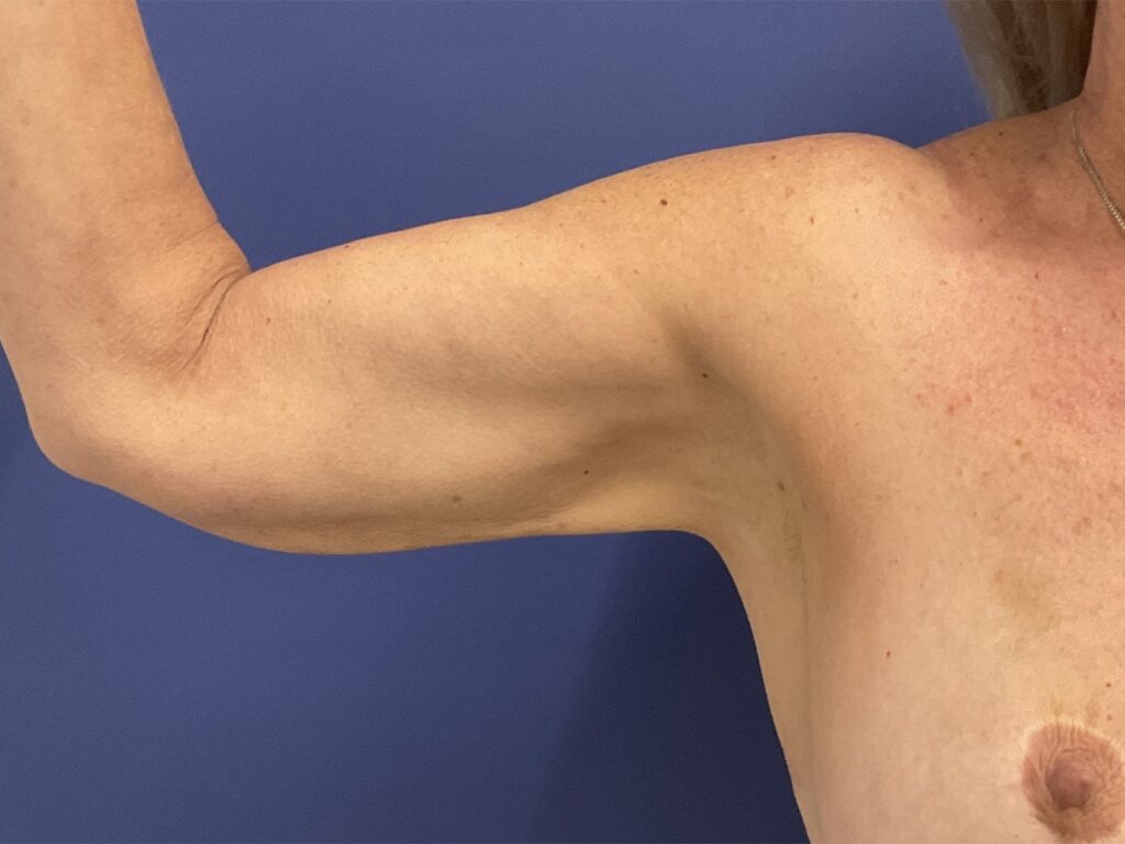 After Image: Patient # 82254 - front