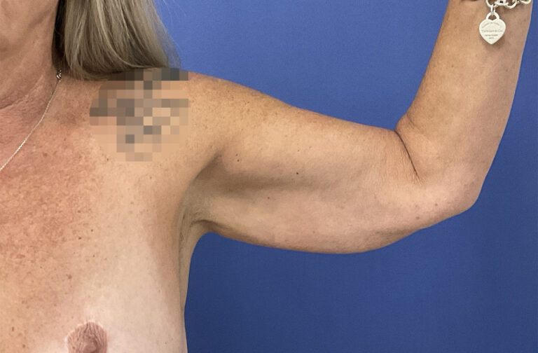 Before Image: Patient # 82254 - front