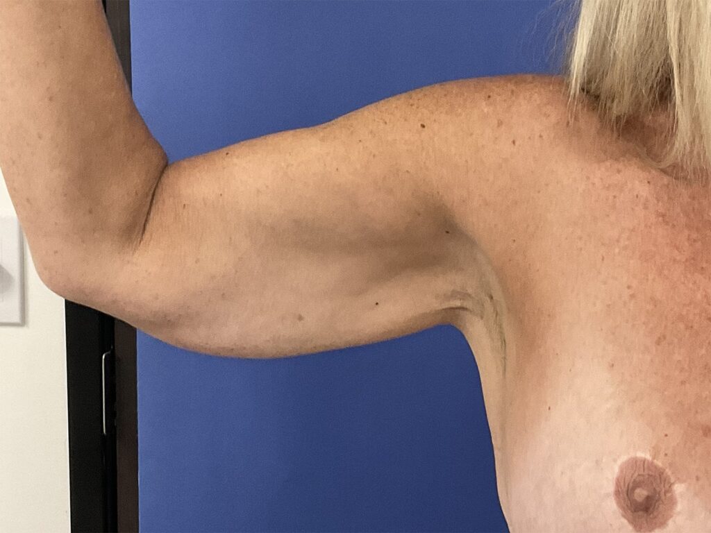 Before Image: Patient # 82254 - front