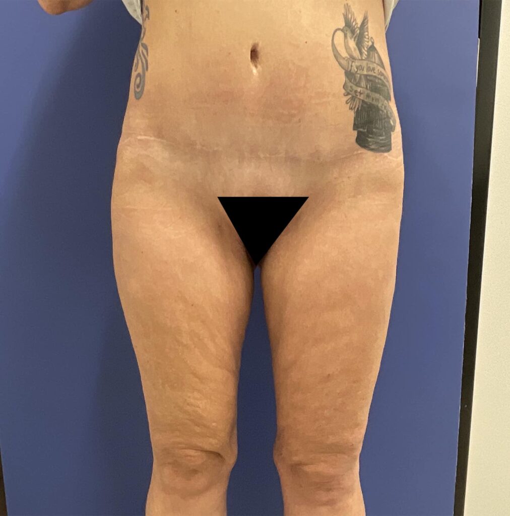 After Image: Patient # 4999 - front