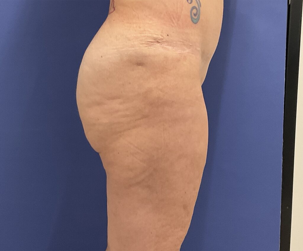 After Image: Patient # 4999 - right-side