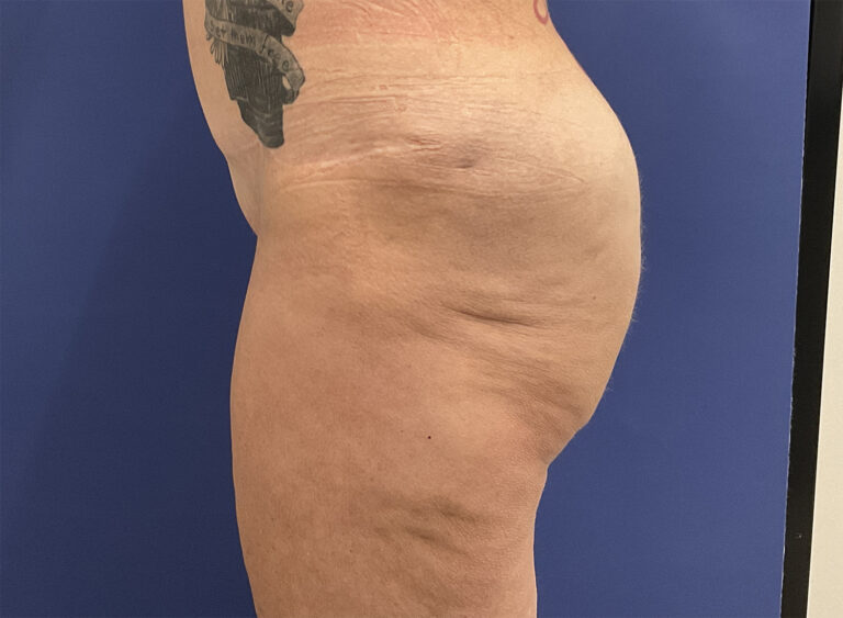 After Image: Patient # 4999 - left-side