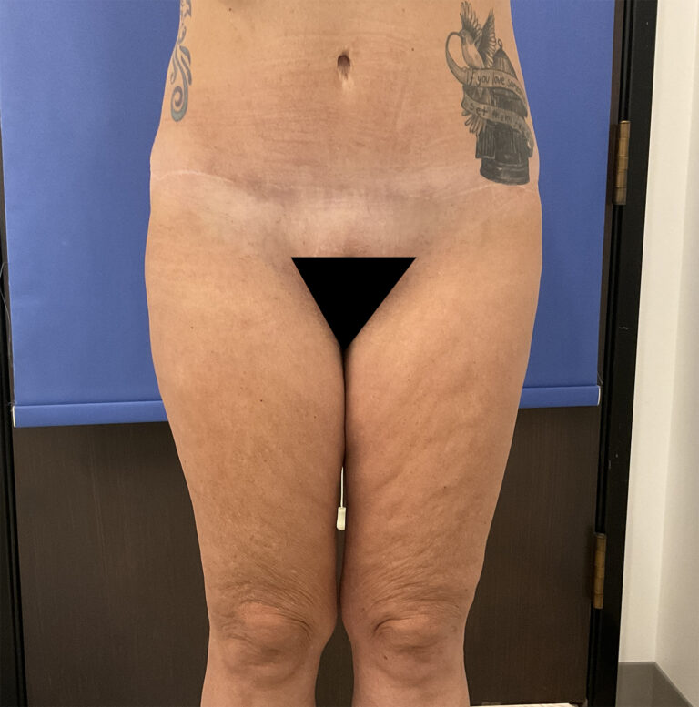 Before Image: Patient # 4999 - front