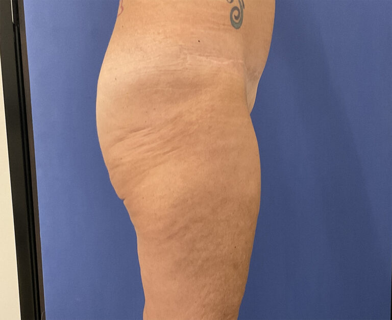 Before Image: Patient # 4999 - right-side