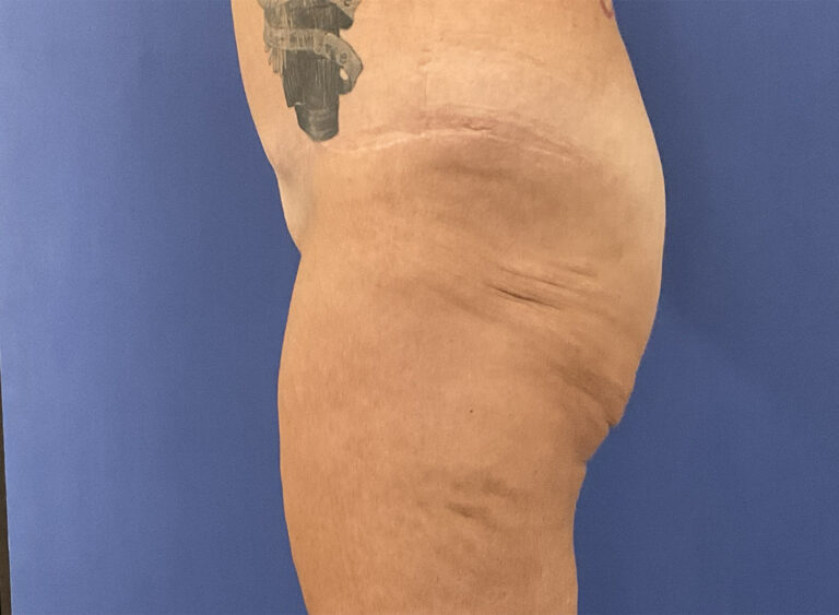 Before Image: Patient # 4999 - left-side