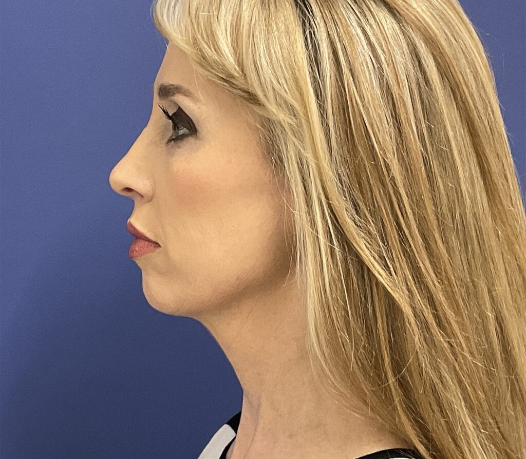 After Image: Patient # 82486 - front