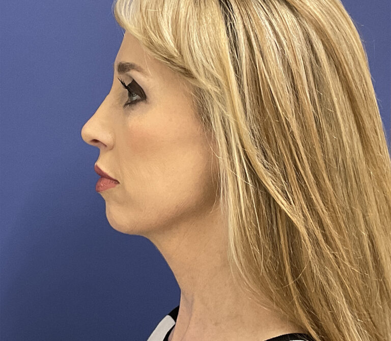 After Image: Patient # 82486 - front