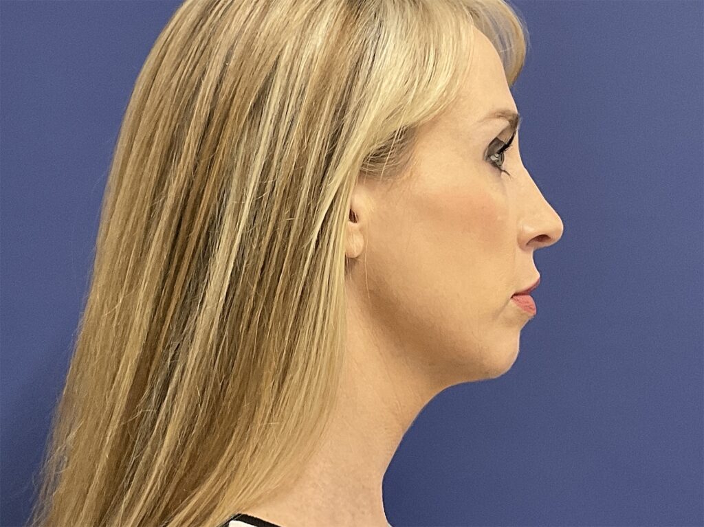 After Image: Patient # 82486 - right-side
