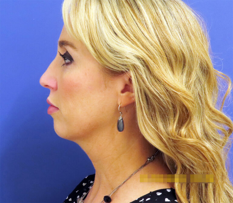 Before Image: Patient # 82486 - front