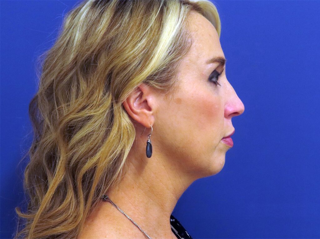 Before Image: Patient # 82486 - right-side