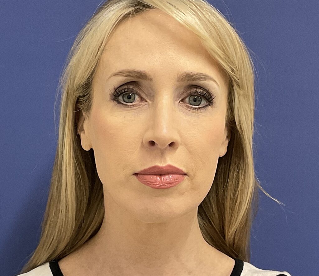 After Image: Patient # 82486 - front