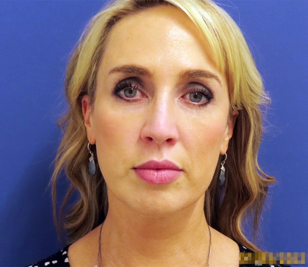 Before Image: Patient # 82486 - front