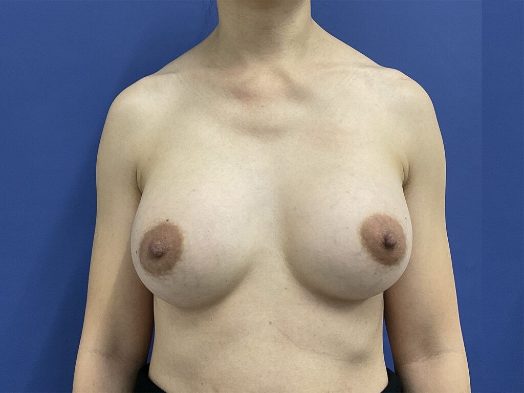 After Image: Patient # 5007 - front
