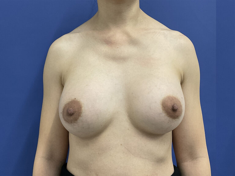 After Image: Patient # 5007 - front