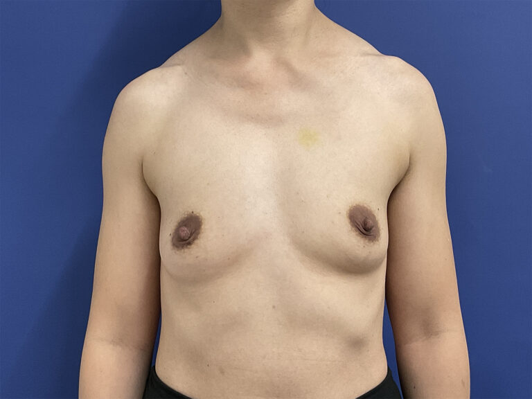 Before Image: Patient # 5007 - front