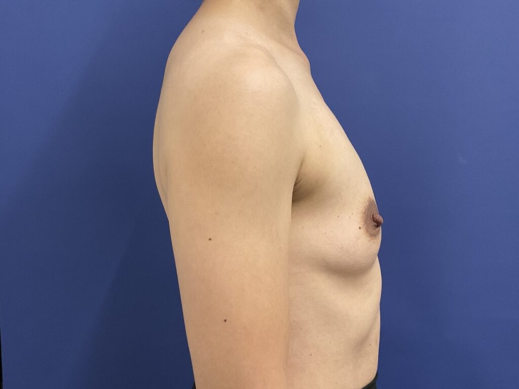 Before Image: Patient # 5007 - right-side