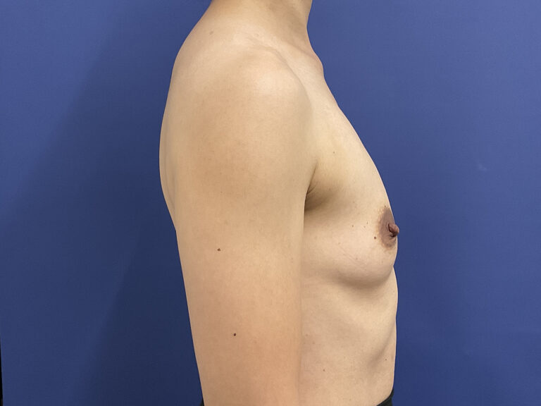 Before Image: Patient # 5007 - right-side