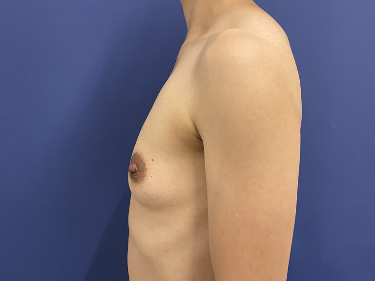 Before Image: Patient # 5007 - left-side