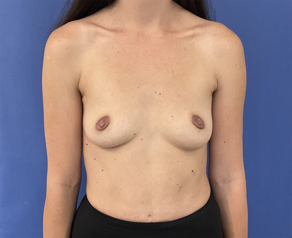 Before Image: Patient # 5016 - front