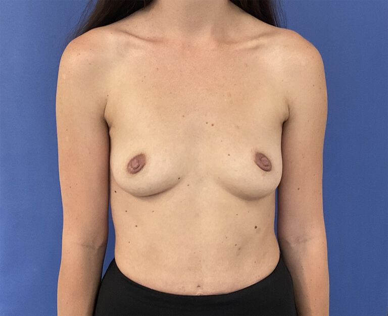 Before Image: Patient # 5016 - front